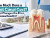 How Much Does a Root Canal Cost? What Changes the Price in Massachusetts?