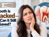 A Tooth Is Cracked—but Can It Still Be Saved?